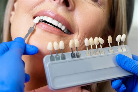 Veneer Techs: What Are They and Why Do Some Dentists Call .